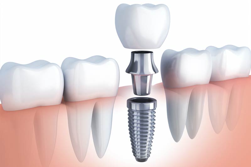 Implants Dentist in Eugene